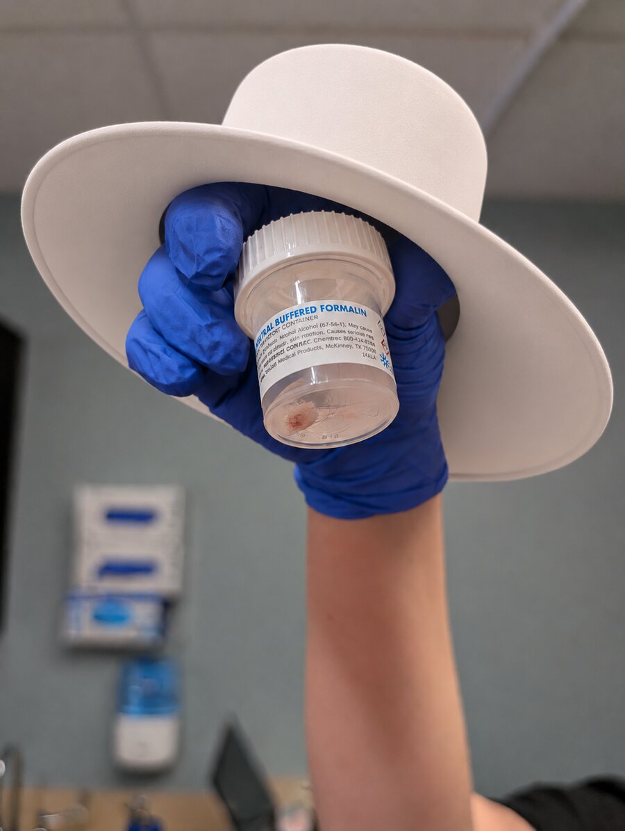 A specimen jar labeled Neutral Buffered Formalin, containing a small tissue sample, wearing a wide-brimmed white hat, held aloft by a gloved hand.